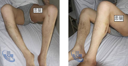 【儿麻案例】小儿麻痹后遗症治疗及人工肌肉治疗粗细腿